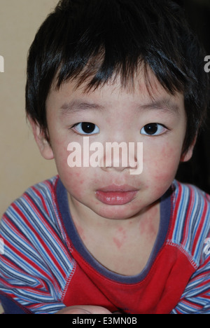 Child with mealses rashes on face and body Stock Photo