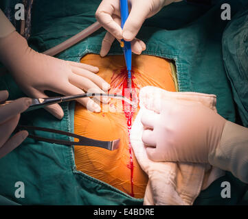 Median sternotomy incision Stock Photo