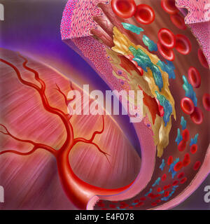 Close-up of artery showing atherosclerotic plaque, platelets and red blood cells. Stock Photo