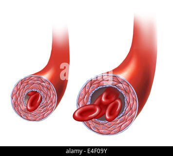 Normal artery versus artery in spasm. Stock Photo