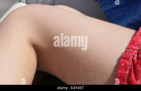 Goose bumps on a human leg. Stock Photo