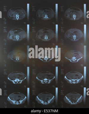 Closeup of a CT scan with chest and abdomen Stock Photo