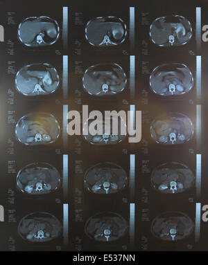 Closeup of a CT scan with chest and abdomen Stock Photo