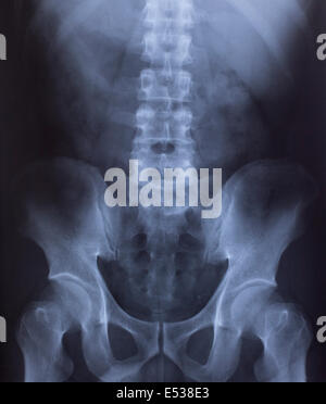 X-ray of the pelvis and spinal column Stock Photo - Alamy