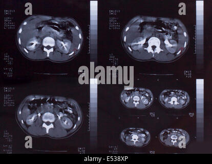 Closeup of a CT scan with chest and abdomen, Stock Photo