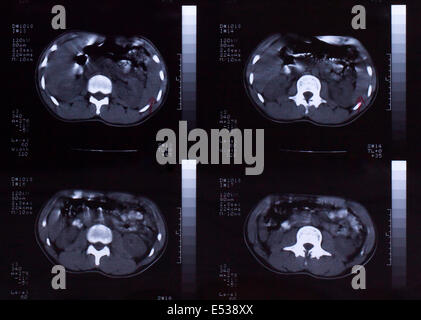 Closeup of a CT scan with chest and abdomen, Stock Photo