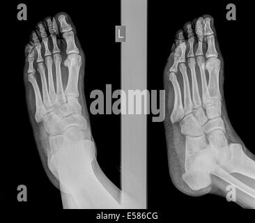 x-ray of a foot showing a fracture in the proximal phalanx of the big ...