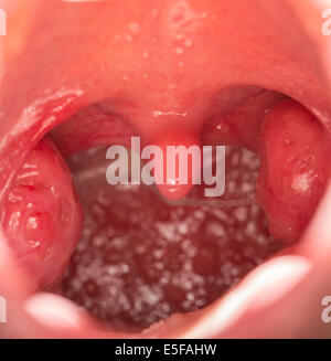 Open mouth view of tonsils Stock Photo