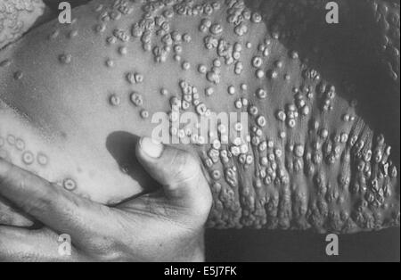 A victim of the Smallpox variola virus. From the archives of Press Portrait Service. EDITORIAL USE ONLY Stock Photo
