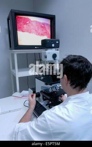 Hemochromatosis, A doctor examinates with an optical microscope (Magnification x 100) liver tissus affected by hemochomatosis Stock Photo