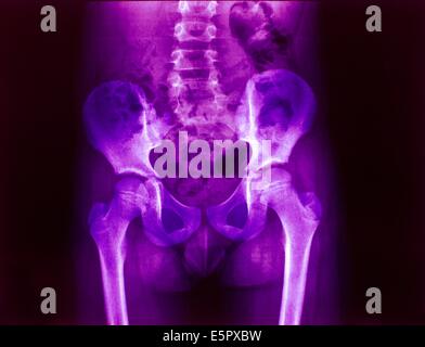 X-ray of a normal pelvis of a child. Stock Photo