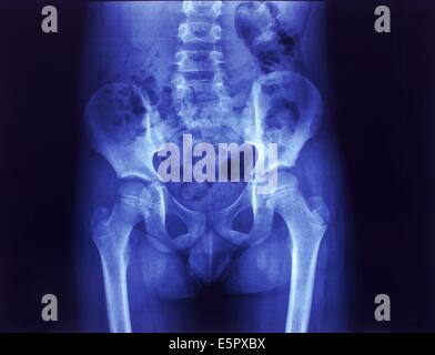 normal hip xray child