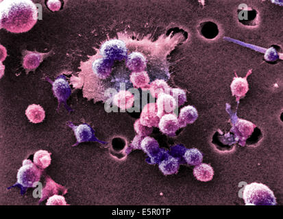 Scanning electron micrograph (SEM) of malignant B-cell lymphocytes seen in Burkitt's lymphoma, Magnification x4000. Stock Photo