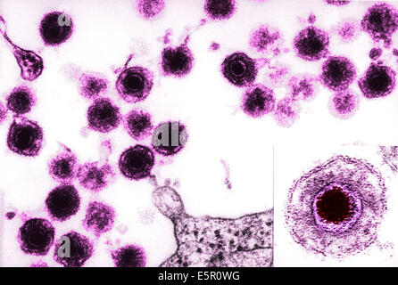 Transmission Electron Micrograph (TEM) Of Human Herpes Virus-6 (HHV-6 ...