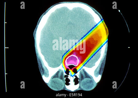 Image of a proton beam irradiating a brain tumor (circled in white). Stock Photo