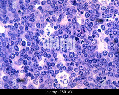 Photomicrograph of malignant B-cell lymphocytes seen in Burkitt's lymphoma, The Epstein-Barr virus has been isolated from Stock Photo