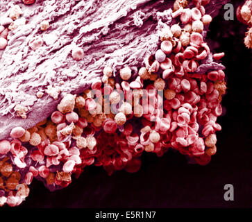 Scanning electron micrograph (SEM) of agglutinated red and white blood cells in a blood vessel. Stock Photo