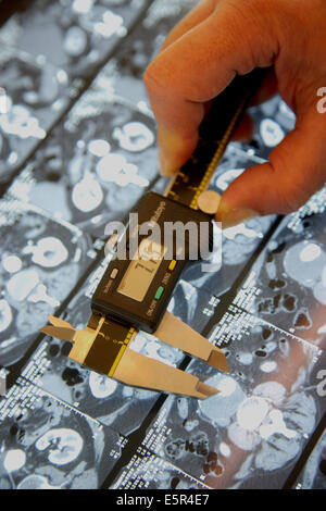 Surgery to treat aortic lesions with custom-made endovascular implants Pr Fabien Koskas Department of vascular surgery, Stock Photo