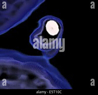 Coloured 3-D computed tomography (CT) scan of the heart showing a stenosis of a coronary artery narrowed by atherosclerotic Stock Photo