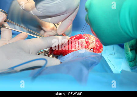 Suture of an lung emphysema surgery in an infant Stock Photo