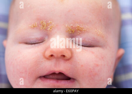 A three week old bay with cradle cap on the eye-brows. UK. Stock Photo