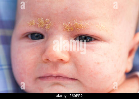 A three week old bay with cradle cap on the eye-brows. UK. Stock Photo