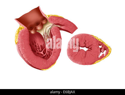 Enlarged left ventricle of the human heart. Stock Photo