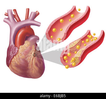 Heart with arteries showing cholesterol in one artery and atherosclerotic plaque in the other. Stock Photo