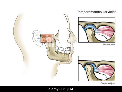 Temporomandibular joint, normal and dislocated. Stock Photo