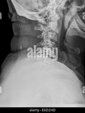 X ray normal cervical spine Stock Photo - Alamy