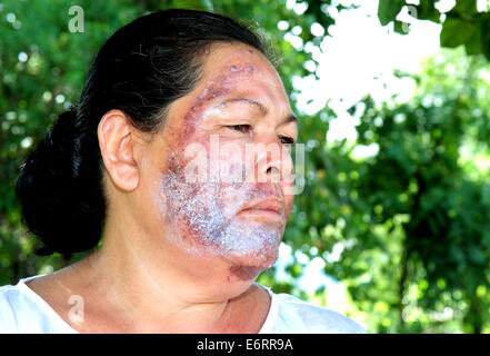 (140830) -- SONORA, Aug. 30, 2014 (Xinhua) -- Image taken on Aug. 19, 2014, shows a woman with her affected faces after cleaning it with water damaed by a toxic spill in the Sonora River, in Sonora, Mexico. According to the Federal Government, on Aug. 6, 2014, the largest environmental disaster in the mining industry in Mexico was recorded, when 40,000 cubic meters of copper sulfate were spilled into a damm of the miner property of Grupo Mexico, contaminating parts of the Tinajas creek, the Bacanuchi River and the Sonora River. According to a dictum of the Federal Government, the spill occured Stock Photo