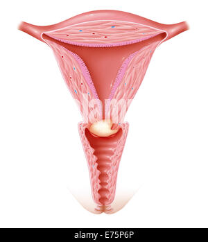 Cervical cancer, drawing Stock Photo