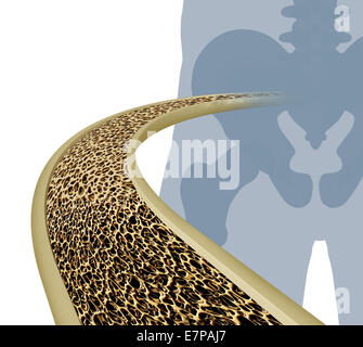 Osteoporosis medical illustration concept as a close up diagram of the inside of a human bone from a skeletal hip joint as a normal healthy condition gradually degrades to abnormal unhealthy bone mass on a white background. Stock Photo