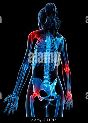 Human anatomy of inflamed joints, computer artwork. Stock Photo