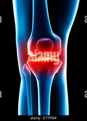Human knee pain, computer artwork. Stock Photo