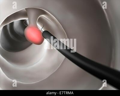 Removal of a polyp in the human colon, computer artwork. Stock Photo