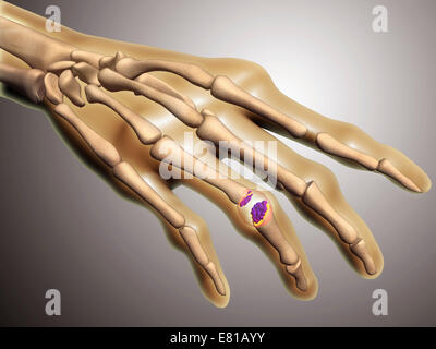 Conceptual image of rheumatoid arthritis (RA) in the human hand. RA is a chronic inflammatory disorder that typically affects th Stock Photo