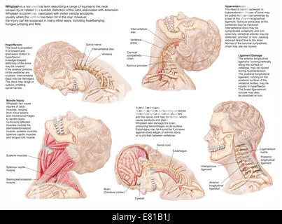 Medical chart showing the range of injuries to the human neck caused by whiplash. Stock Photo