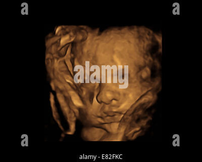 Foetus' face, Coloured 3-D ultrasound scan of a foetus, Gestational age ...