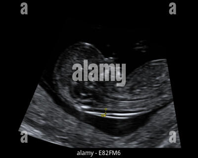 Ultrasound scan of a foetus showing nuchal scan for Down's Syndrome ...