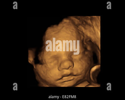 Foetus' face, Coloured 3-D ultrasound scan of a foetus, Gestational age ...