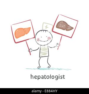 hepatologist holding signs with healthy and diseased liver Stock Vector