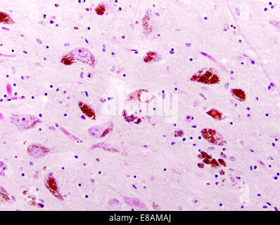 Parkinson's disease, substantia nigra, Lewy bodies Stock Photo