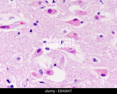Brain hypoxia, hippocampus, neurons Stock Photo