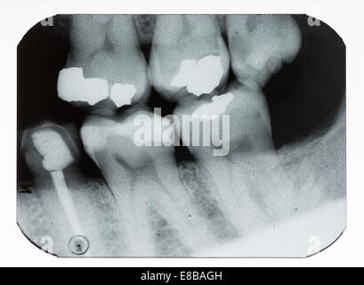 Dental xray x-ray film showing rows of traditional amalgam fillings and ...