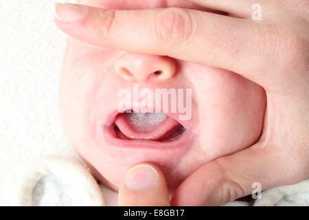 Close-up of oral thrush (candidiasis, white) on the palate of the mouth ...