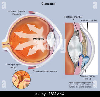 Retina of eye with glaucoma. Stock Photo