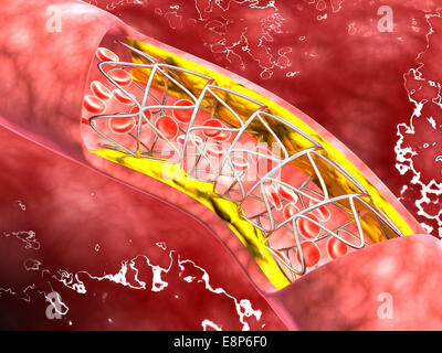 Microscopic view of an artery cross-section with blood flow, fat plaque and stent deployment. Stock Photo