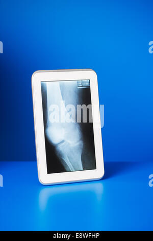 Digital tablet displaying x-ray on blue counter Stock Photo