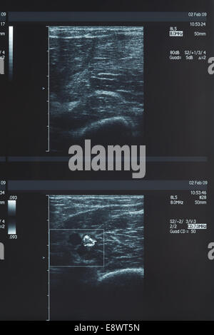 X-ray, muscle ultrasound Stock Photo